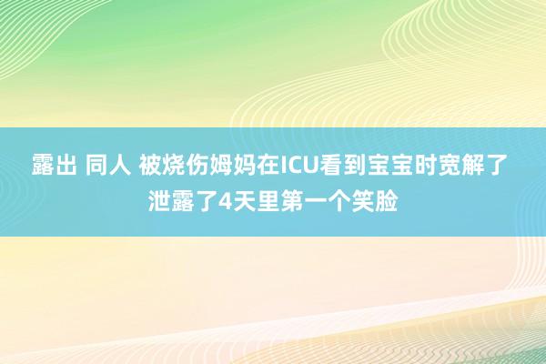 露出 同人 被烧伤姆妈在ICU看到宝宝时宽解了 泄露了4天里第一个笑脸